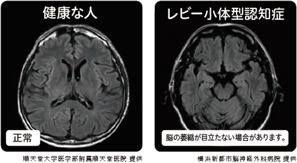 MRI検査の画像（正常、レビー小体型認知症）