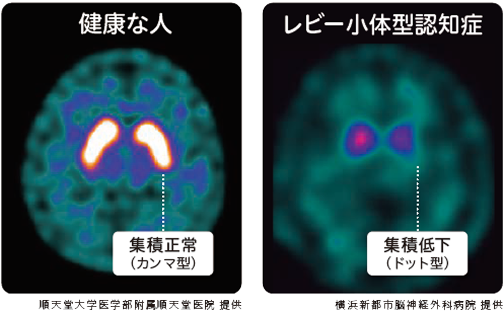 同じ時期のSPECT検査の画像（正常、レビー小体型認知症）